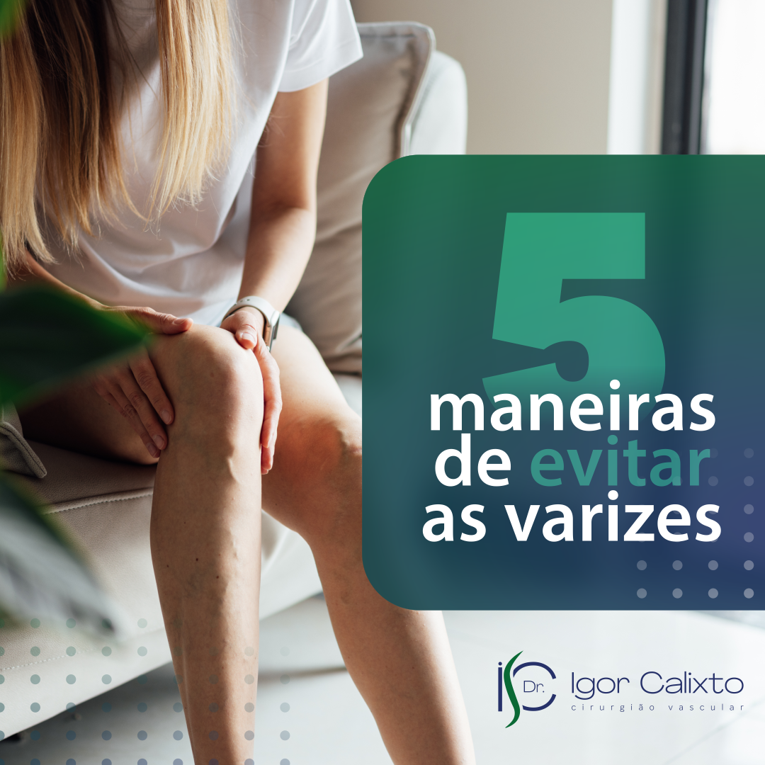 5 MANEIRAS DE EVITAR AS VARIZES.
