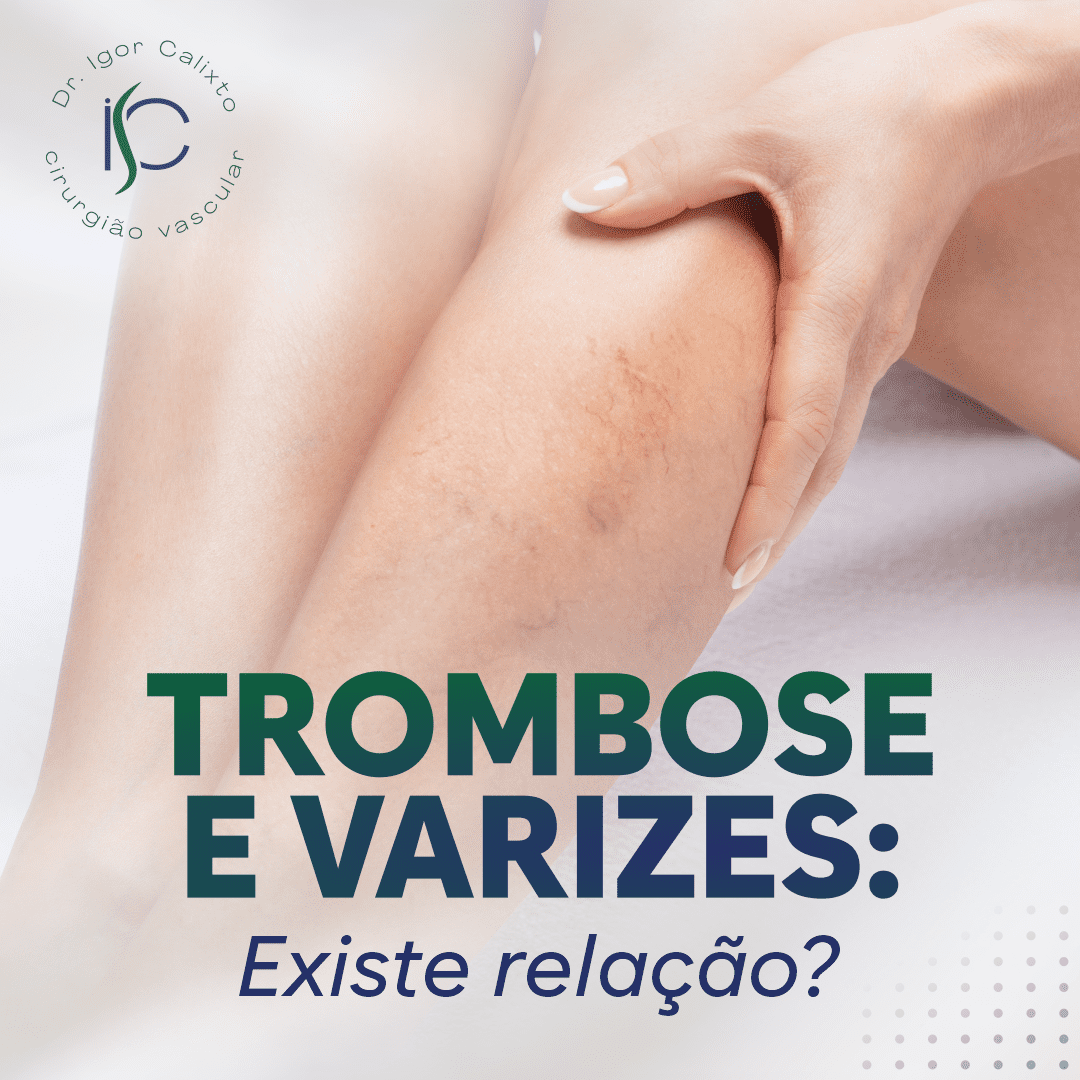 Trombose e varizes: existe relação?